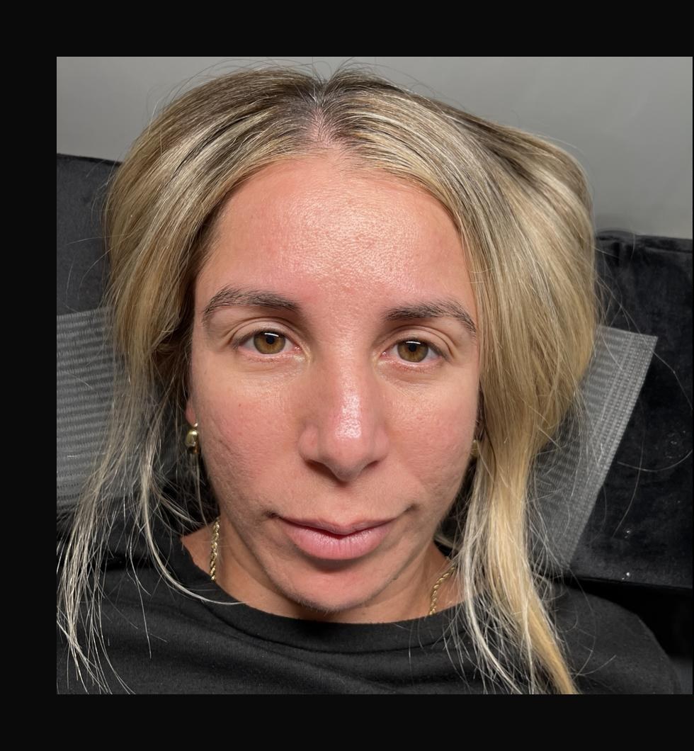 After lash set